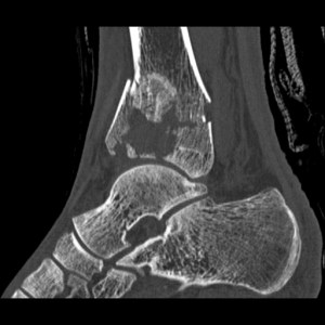 kc - pilon distal tibia(2)004410