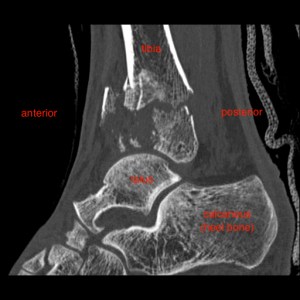 kc - pilon distal tibia(1)004413
